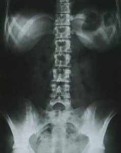 Ap Abdomen Ap Abdomen