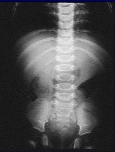 Ap de abdomen agudo - invaginacion