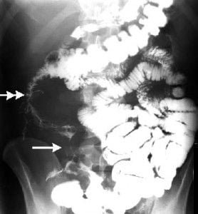 Tumor maligno ileon terminal