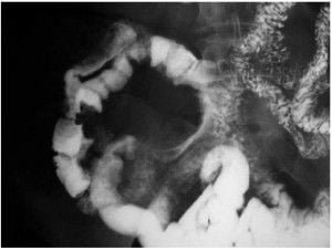 Enfermedad inflamatoria intestinal