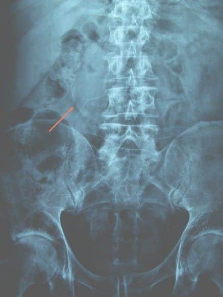 Proyeccion ap sipmle de abdomen agudo