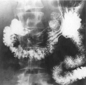 TEGD 8 - DUODENO EN ANTEROPOSTERIOR