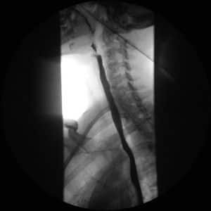 Transito esofagico de un transito esofagogstroduodenal 2