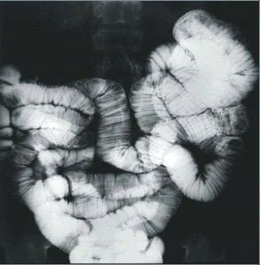 Transito intestino delgado I