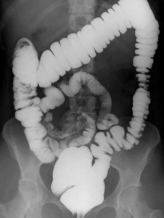 contraste simple en un enema opaco