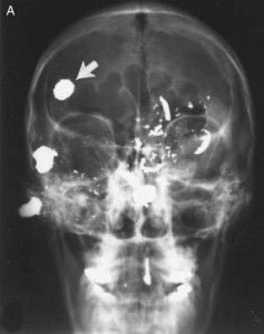 Vista frontal craneo herida de bala craneo herida de bala