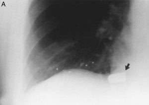 Vista frontal torax herida de bala torax herida de bala