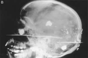 Vista lateral craneo herida de bala craneo herida de bala en vision lateral