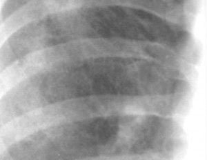 Aspecto en vidrio deslustrado Aspecto granular