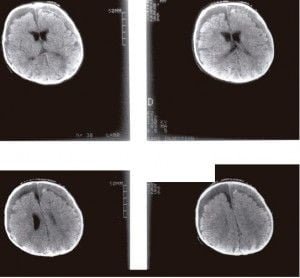 RM de hematoma subdural bilateral
