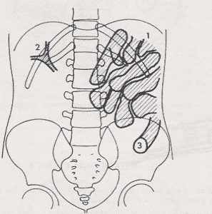 obstruccion en abdomen simple