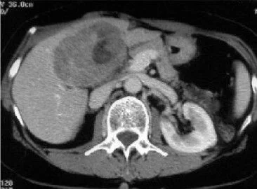 Hepatocarcinoma
