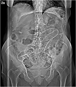 scout abdomen y pelvis