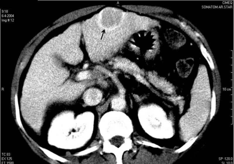carcinoma hepato-celular