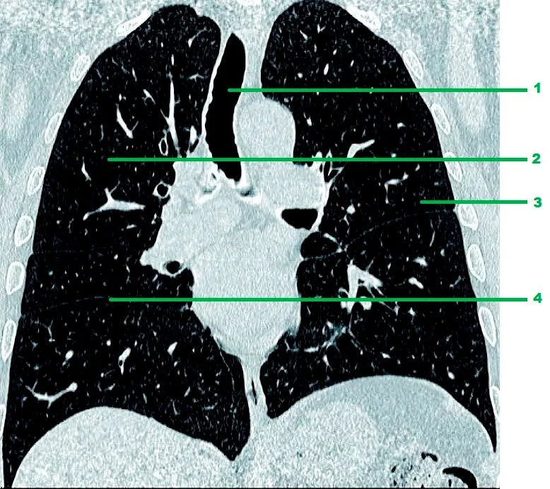 Vías aéreas en TAC