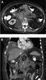 Absceso en pancreas