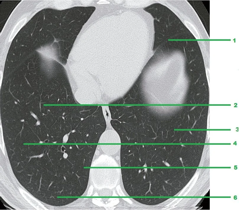 Lungs and Interstitial Network