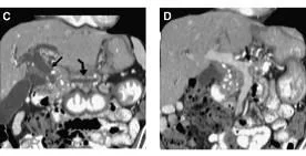 Pancreatitis coronal oblicua
