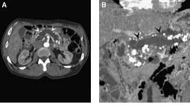 Pancreatitis