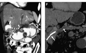 pancreatitis con stent